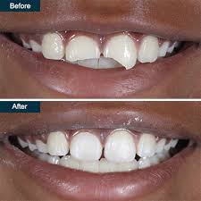 Everyone wants a gorgeous smile. Broken Cracked Tooth Repair Brooklyn Ny Top Rated Cosmetic Dentist