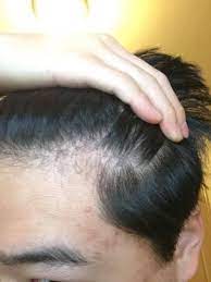 Hair thinning is a reduction in the hair's density. 18 Y O Is This The Start Of Diffuse Thinning Hairlosstalk Forums