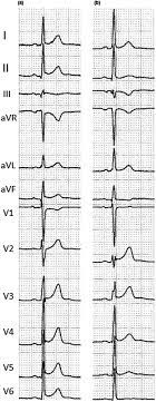 Treatment mainly involves preventing heart failure with medication and diet. Diagnostic And Prognostic Role Of Electrocardiogram In Acute Myocarditis A Comprehensive Review Butta 2020 Annals Of Noninvasive Electrocardiology Wiley Online Library