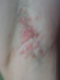 Ausschlag Unter Den Armen Achseln Seit Zwei Wochen Bepanthen Und Zinksalbe Sind Nicht Hilfreich Was Kann Ich Noch Tun Gesundheit Dermatologie Hautausschlag