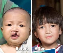 Meet Folksong, a brave young boy from Thailand! Born with a #cleft lip and  cleft palate, Folksong's parents were determined to give him the best  possible future they could. Despite financial concerns,