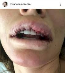 Roxana muñoz is an actress, known for teatro en chv (2003), año 0 (2011) and fiebre de baile (2009). Roxana Munoz Muestra Los Graves Danos Que Dejo En Sus Labios Un Mal Procedimiento Estetico Meganoticias