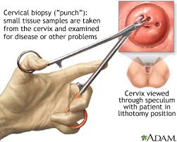 Cervical cancer pictures and videos. Cervical Cancer Medlineplus Medical Encyclopedia