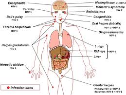 There are two types of hsv: Herpes Simplex Virus 2 Infection Molecular Association With Hiv And Novel Microbicides To Prevent Disease Springerlink