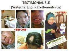 Adalah jenis odapus yang paling sering terjadi. Penyakit Sle Atau Lupus Boleh Membawa Maut Rose Emalda