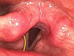 Image result for Reflux Laryngitis