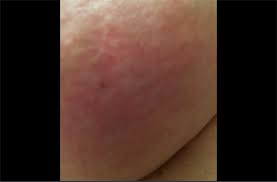 If identified early, the disease can be treated effectively with excellent prognoses. I Was Told That My Bra Was Too Small Mother Shares Picture Of Rash To Raise Awareness Of Rare Breast Cancer