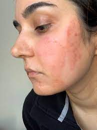 What happens when you use glycolic acid on your skin? The Painful Lessons I Learned After The Ordinary Gave Me Chemical Burns Dazed Beauty