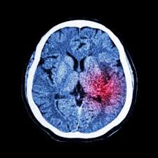 Strokes are the major cause of disability in adults, worldwide. Stroke New Drug Limits Brain Damage And Promotes Repair