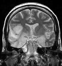 A case of granulomatous hsv encephalitis: Herpesviral Encephalitis Wikipedia