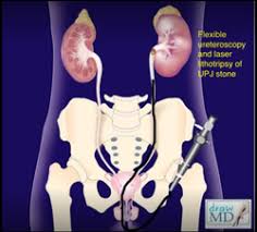 Laser Kidney Surgery And Kidney Stones Treatment Service Nursing Homes Clinics Hospitals Tirupur Kidney Center Tiruppur