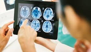 Other signs and symptoms of brain metastases include: What Happens When Cancer Spreads To The Brain Moffitt