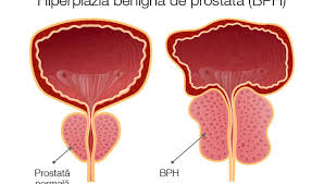De ce nu poti sa slabesti tot mai mult manancand tot mai putin. Hiperplazia Benigna De Prostata Hbp Semne Simptome Cauze Factori De Risc Diagnostic Tratament Reginamaria Ro