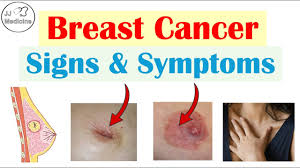 Image result for Breast Cancer