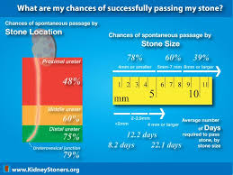 6 Infographics To Help You Avoid A Kidney Stone Attack Like The One That Struck Amazon Ceo Jeff Bez Passing Kidney Stones Kidney Stones Medullary Sponge Kidney