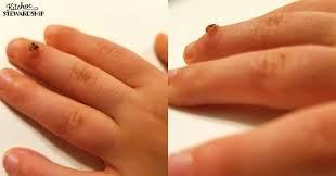 Go to places where people walk around barefoot in wet areas. 3 Step Home Remedy For Warts Kitchen Stewardship