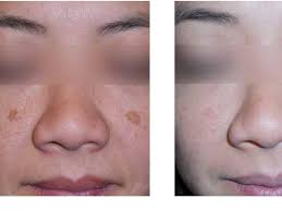 Image result for Solar Lentigo