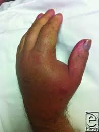 Image result for Cat Bite