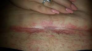 Should I Worry If I Have A Yeast Infection After My C Section