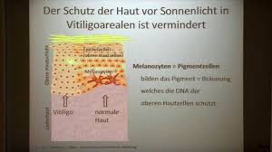 Vitiligo oder auch weißfleckenkrankheit genannt ist eine hauterkrankung, bei der sich die haut an unterschiedlichen stellen des körpers weiß verfärbt. Warum Sonnenschutz Bei Vitiligo So Wichtig Ist Vitiligo Online De