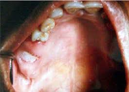 Image result for Alveolitis sicca)