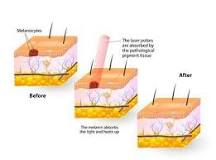 Image result for how much is laser treatment for underarms