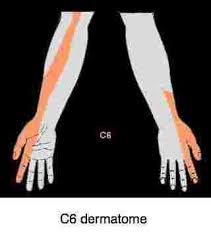 Thoracic Outlet Syndrome Is A Not Uncommon Cause Of An Aching Tingling Arm Tingling Hands Tingling In Fingers Numbness In Hands