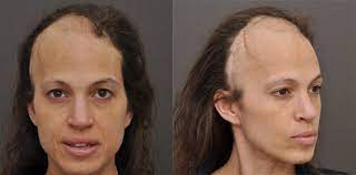 Cancer Patients Reconstructive Hair Transplant Update News Testimonial Mcgrath Medical