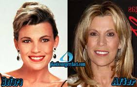 Happy 58th birthday vanna white see 10 classic game . Vanna White Plastic Surgery Before And After Photos Plastic Surgery Facts