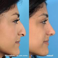 15 Things You Should Know About Nose Jobs Rhinoplasty Nonsurgical Nose Job Rhinoplasty Surgery