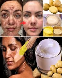 Removing dark spots with potatoes and ginger