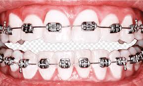 Cleaning different kinds of braces | even if you wear braces, you can, and should, brush and floss your teeth consistently. Teeth Whitening Png Images Pngegg