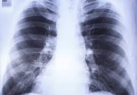 Image result for Parapneumonic Effusion