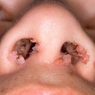 Tem origem num grupo de vírus que afeta a pele e as mucosas (revestimento interno das cavidades do corpo, como a. Verrugas Sociedade Brasileira De Dermatologia