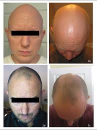 A universal loss of hair, from head to toe. A Case Report Highlighting The Effective Treatment Of Alopecia Universalis With Tofacitinib In An Adolescent And Adult Patient Semantic Scholar