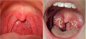 This picture gallery contains some examples of the more common. Throat Cancer Signs And Symptoms Celine Dion Songs Age