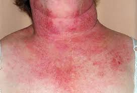 Image result for Photodermatitis