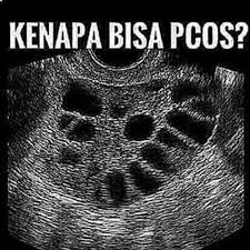 Penyebab penebalan dinding rahim terjadi akibat stimulasi hormon estrogen yang tidak diimbangi oleh progesteron. Positif Hamil 2 Bulan Posts Facebook