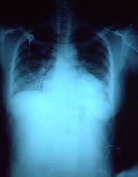 Manit shah in स्वास्थ्य 4 years ago. Lung Congestion Medical Condition Britannica