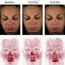 Skin hydration at baseline (T0) and after one application of the test...