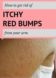 How To Get Rid Of Itchy Red Bumps From Your Arm Itchy Red Bumps Skin Bumps Leg Pimples