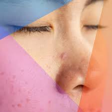 How To Get Rid Of And Prevent A Pimple Inside Your Nose