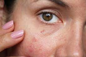 Stopping blood vessels before they begin, or working to prevent any more from form, will prevent additional treatments in the future. Broken Blood Vessels On Face And Nose Dr Haus Dermatology