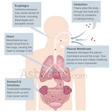 Treatment for this disease may include surgery, chemotherapy, radiation therapy, and immunotherapy. Pin On Asbestos Ban In India
