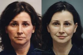 Facelift in Houston, TX