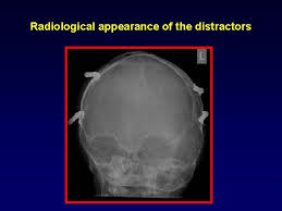 Librivox is a hope, an experiment, and a question: Managing Intracranial Hypertension In Syndromic Craniosynostosis A Report