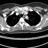 It also helps doctors predict how well you will recover.find the right place for a biopsy.plan 1