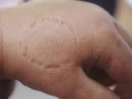 Image result for Human Bite