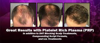 Hair Restoration Treatment Hpi Hair Partners Nashville Platelet Rich Plasma Low Level Laser Therapy Scalp Treatment