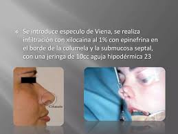 Tutorial septoplastia practica hospitalaria quinto semestre